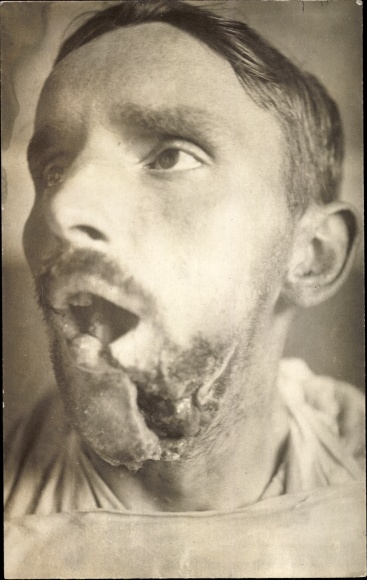 FotoAk Gliwice Gleiwitz, Ned. Ambulance Dutch. Red Cross, war invalid, destroyed jaw