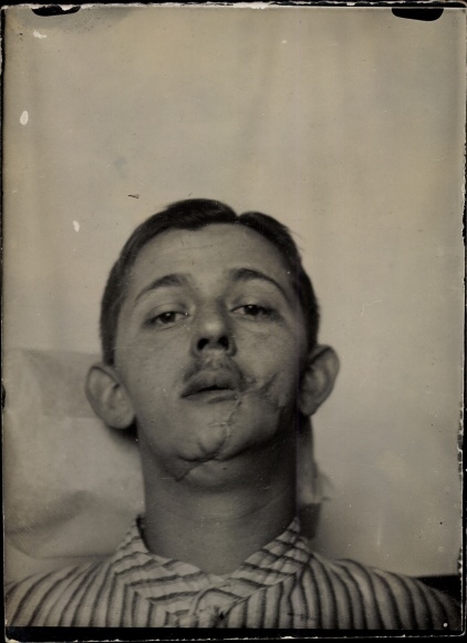 Photo Gliwice Gliwice, military hospital Netherlands. Red Cross, war invalid Daberitz, jaw injury