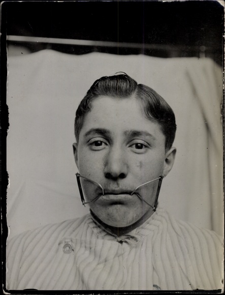 Photo Gliwice Gliwice, military hospital Netherlands. Red Cross, war invalid Scharlier, jaw clip