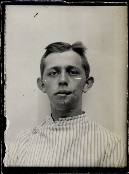 Photo Gliwice Gliwice, military hospital Netherlands. Red Cross, war invalid Daberitz, jaw injury