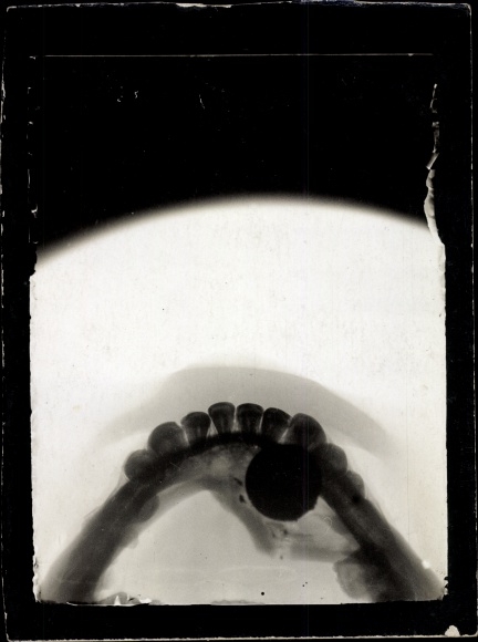 FotoAk Gliwice Gleiwitz, Netherland hospital. Red Cross, X-ray jaw of a war invalid