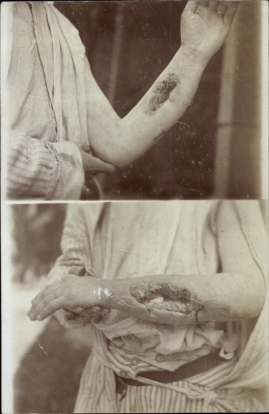 FotoAk Gliwice Gleiwitz, Ned. Ambulance Dutch. Red Cross, war invalid, forearm injury