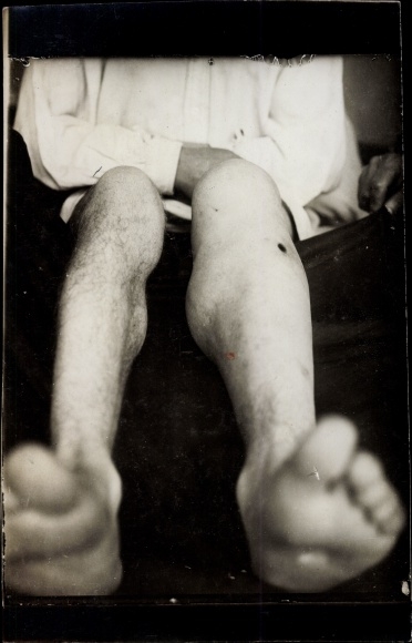 Photo Gliwice Gliwice Upper Silesia, Netherlands. Red Cross, military hospital, legs of a war invalid
