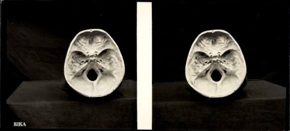 Stereo photo of human skull, BIKA