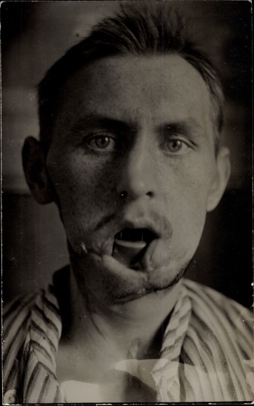FotoAk Gliwice Gleiwitz, Netherland hospital. Red Cross, war invalid Müller, jaw injury